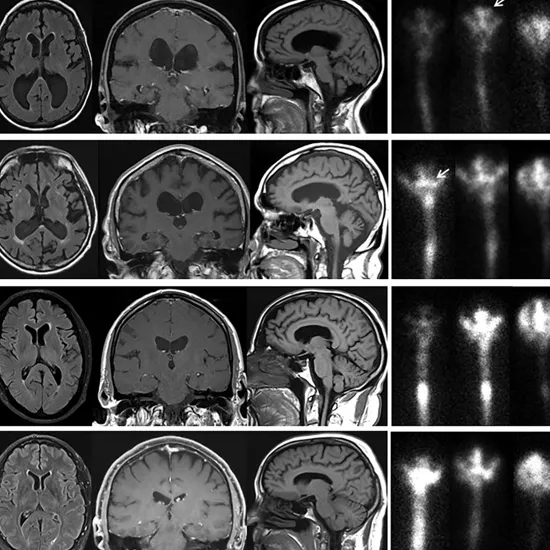 MRI Cisternography Head